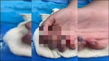 Niña de 11 años resulta con su dedo mutilado tras accidente en supermercado de Curicó