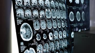 Fármaco anticonvulsivo muestra potencial para prevenir el alzhéimer