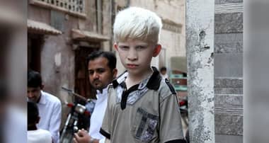 Inédito censo de albinos para saber cuántos son en Chile