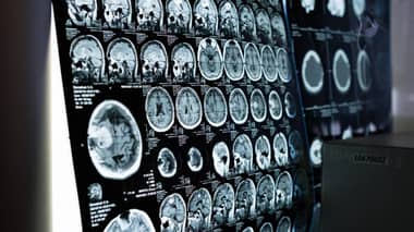 Fármaco anticonvulsivo muestra potencial para prevenir el alzhéimer