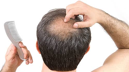 Lo que debes saber: Siete mitos y verdades de la caída del pelo