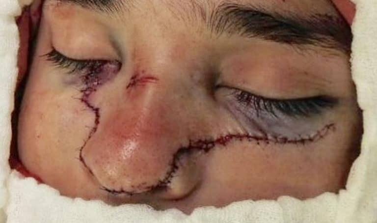 Carabinero quedó desfigurado tras accidente con galletera