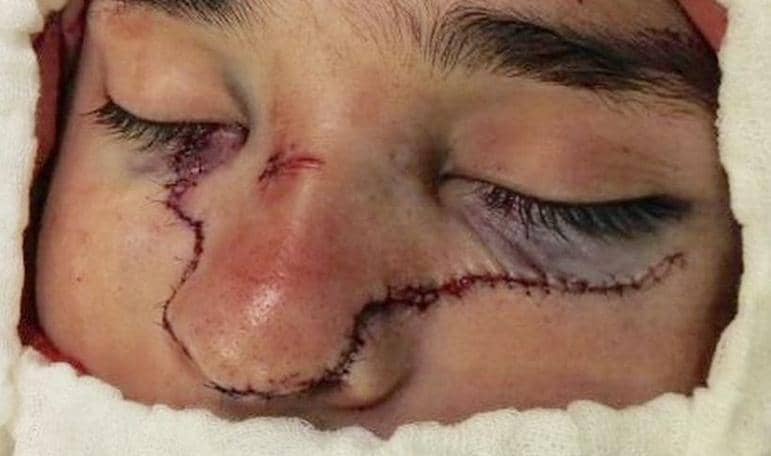 Carabinero quedó desfigurado tras accidente con galletera