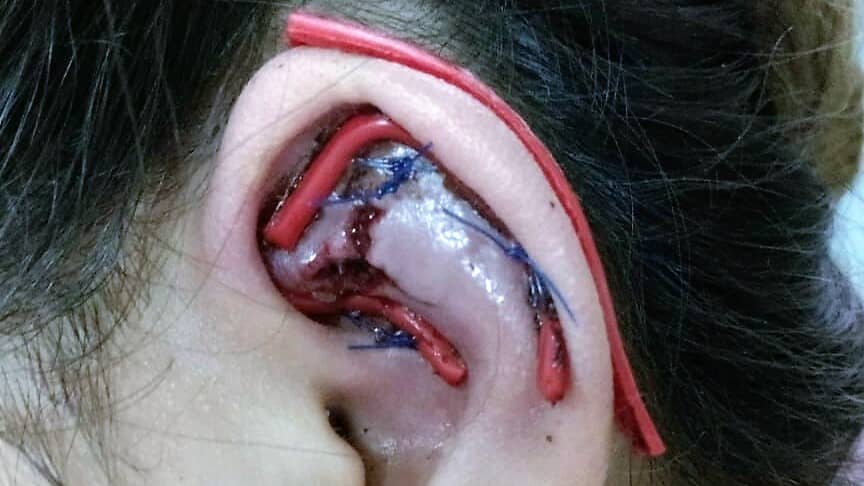 Joven a punto de perder oreja por instalación de piercing