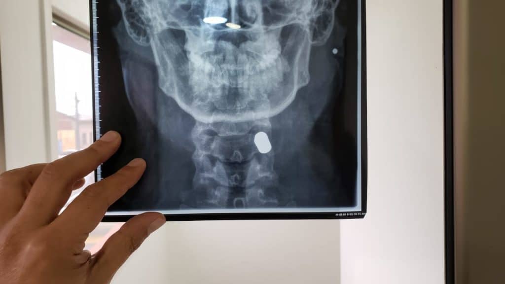 Joven tenino se mantuvo 46 días con bala alojada en el cuello