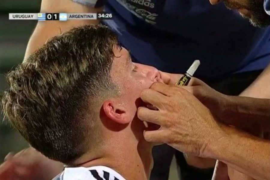 Insólito tratamiento de herida de jugador trasandino: fue sellada con La Gotita