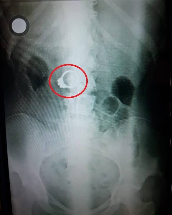Adolescente se tragó anillo de oro que robó en una joyería de Curicó