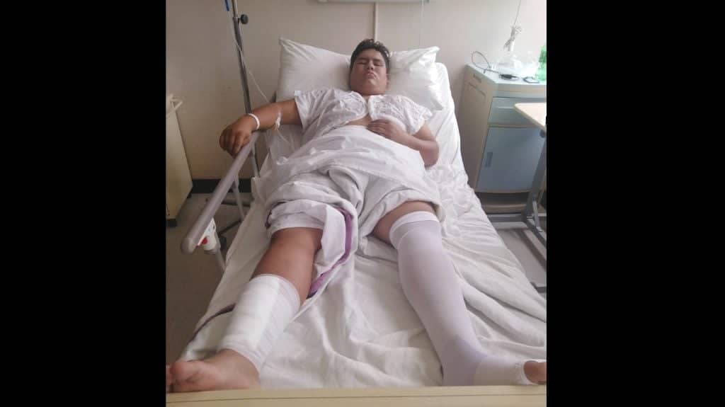 Joven picado por una medusa en Iloca podría perder su pierna por infección