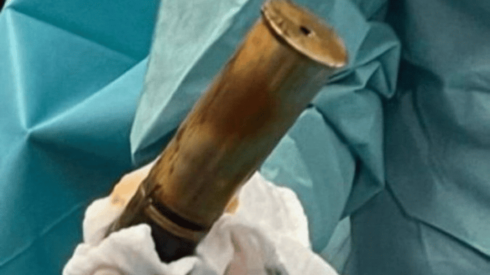 Adulto mayor con bomba de la Primera Guerra Mundial en el ano obligó a evacuar hospital en Francia