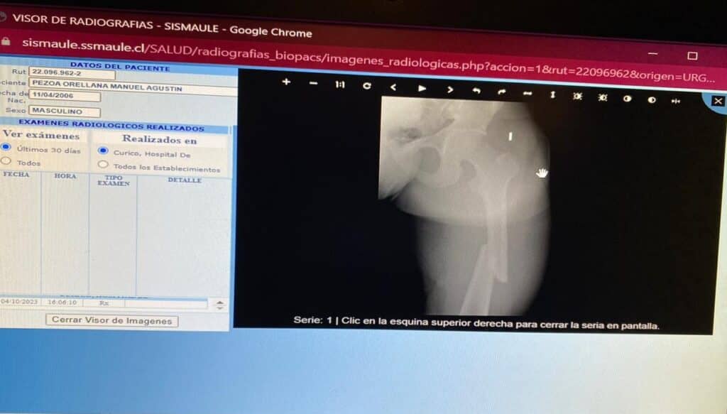Padre de alumno que se fracturó el fémur denuncia falta de traumatólogo en Hospital de Curicó