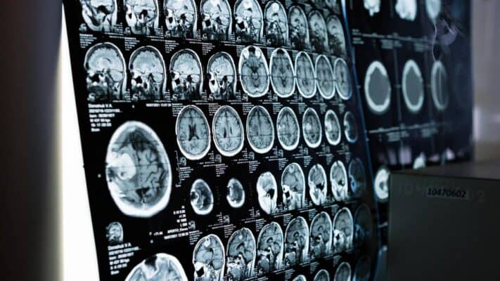 Fármaco anticonvulsivo muestra potencial para prevenir el alzhéimer