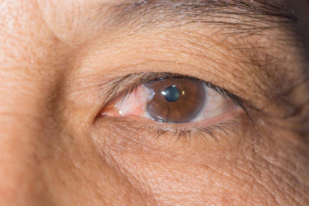 Glaucoma enfermedad silenciosa afecta a más de la mitad de la población sin saberlo