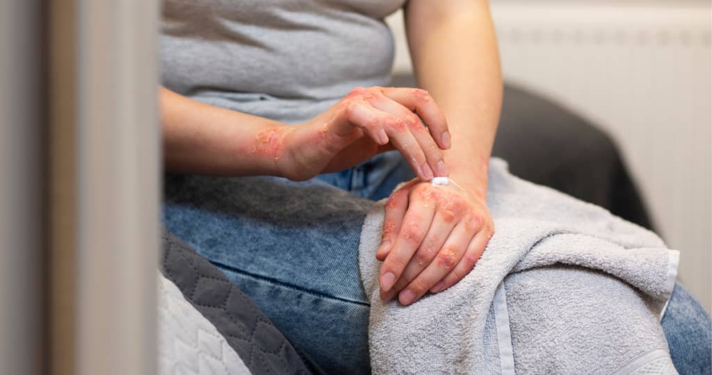 Alerta sanitaria: Aumentan los casos de sífilis en el país