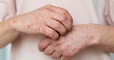 Chile confirma segundo caso de sarampión