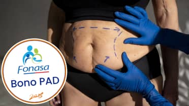Fonasa amplía cobertura del Bono PAD para abdominoplastías reconstructivas