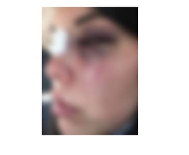 Carabineros informó como “pauta de riesgo baja” brutal agresión de joven de Molina a manos de conviviente