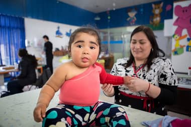 Coaniquem del Maule hace llamado a las autoridades a crear subvención para protección de niños quemados