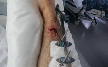 Confirman impacto balístico en hincha herido en las afueras del Estadio La Granja