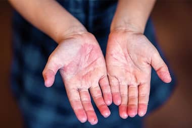 Alerta por escarlatina en el Maule: Nuevo caso en Molina suma seis contagios en la región