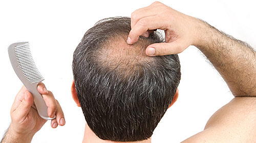 Lo que debes saber: Siete mitos y verdades de la caída del pelo