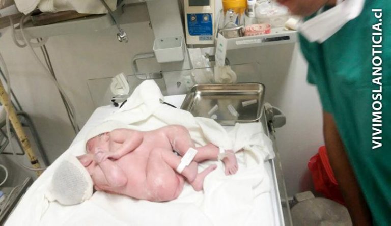 Diagnóstico lapidario: siamesas no sobrevivirán al largo plazo