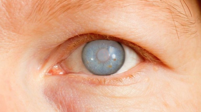 Departamento de Salud Municipal celebrará la Semana del Glaucoma