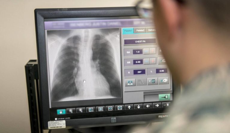 ¿Cómo una radiografía puede ayudar al diagnóstico de COVID-19?