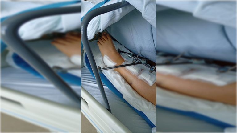 Mujer se accidenta en parque de Curicó; esposo analiza querella contra el municipio