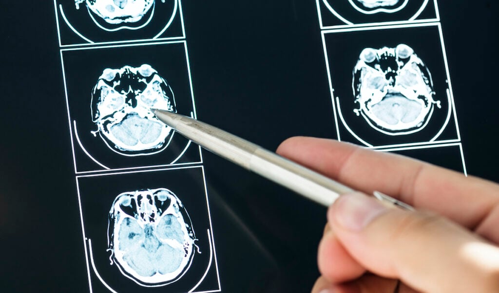 Fin a los traslados: Hospital de Curicó comienza a realizar neurocirugías y reduce listas de espera