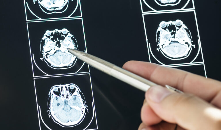 Fin a los traslados: Hospital de Curicó comienza a realizar neurocirugías y reduce listas de espera