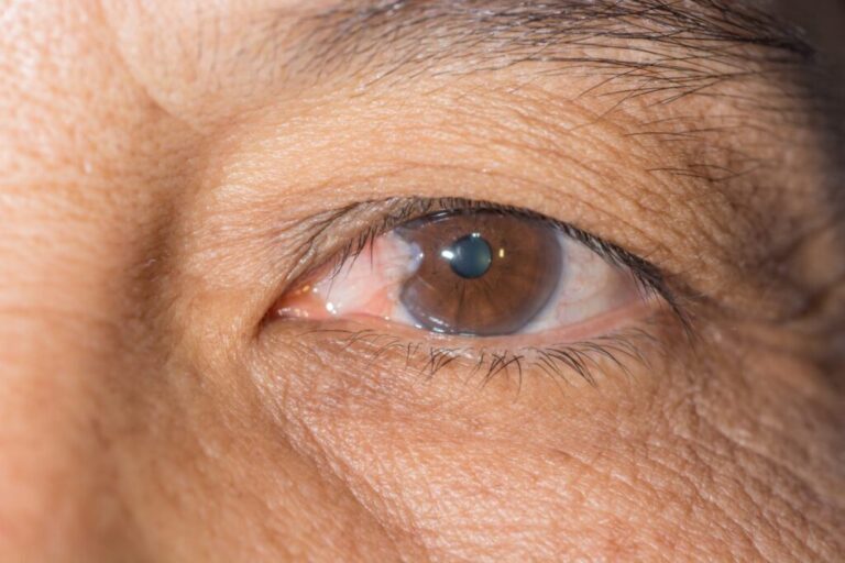 Glaucoma enfermedad silenciosa afecta a más de la mitad de la población sin saberlo